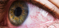 眼睛有红血丝，该怎么消除？